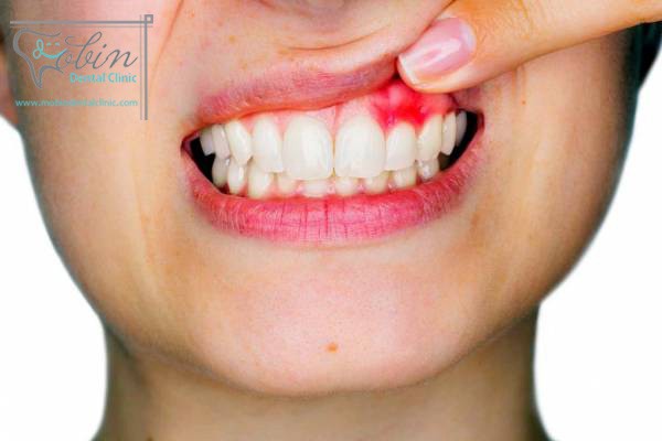 ضررها و عوارض لمینت دندان
